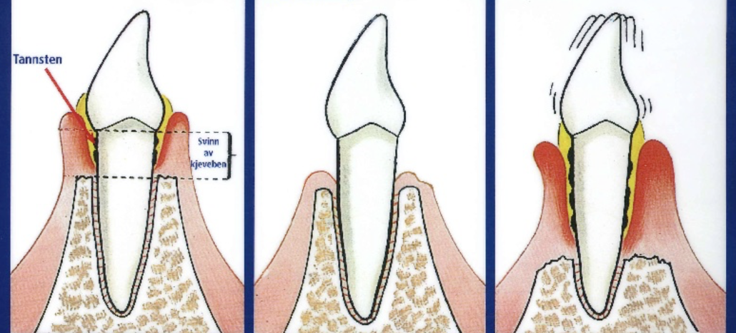 Illustrasjon av utvikling av tannkjøttbetennelse