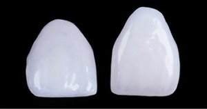 Zirconia fasetter